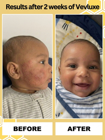 Vevlux's™ Honey Eczema Cream